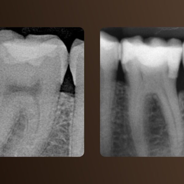 Woodpecker Apex locator Woodpex X With MHN - Image 5